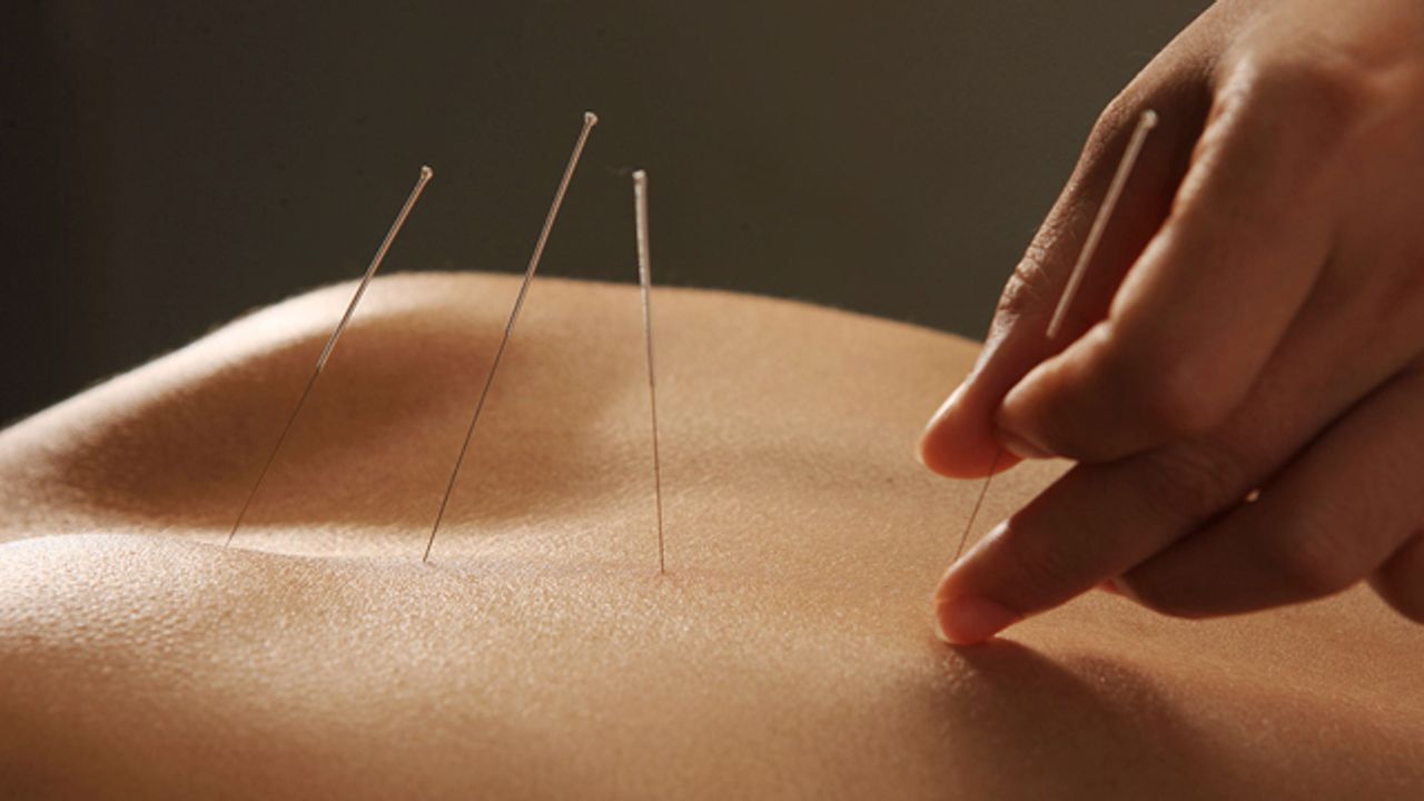 Akupunktur ile kilo verme daha kolay