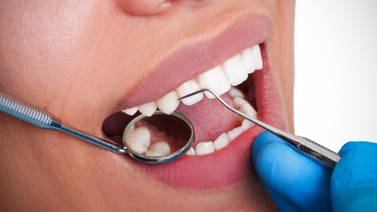 Diş taşı temizliğinde doğru bilinen yanlışlar
