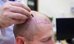 Fizyomer Estetica saç ekim merkezi açıldı