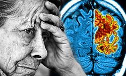 Herpes Virüsü, Alzheimer'ın Gelişimiyle Bağlantılı Olabilir