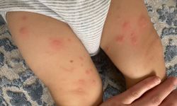 Çocuklarda Artan Besin Alerjileri ve Hayati Riskler