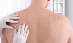Cilt Kanseri Nedir? Tehlikeli Hücre Büyümesi