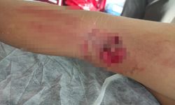 Okula giderken sokak köpeğinin saldırısına uğradı
