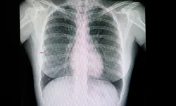 "Akciğer nodülü kanser işareti olabilir"