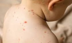 ABD’de kızamık alarmı: yüzlerce kişi izolasyonda