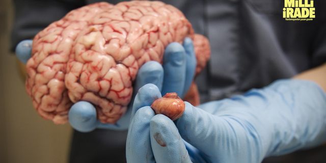 Beyin tümörünün en önemli belirtileri nelerdir?