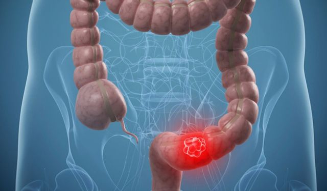 Beslenme alışkanlıkları bağırsak kanserini tetikliyor