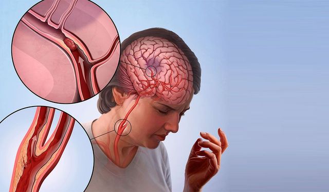 İnme Sonrası Ağız Bakımı Akciğer Enfeksiyonu Riskini Azaltıyor