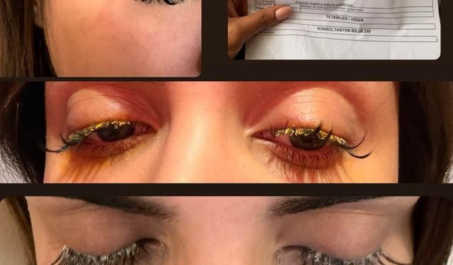 Güzellik merkezinde dehşet: Kirpik yapıştırıcısı gözüne kaçan genç kadın kör olma tehlikesi atlattı!