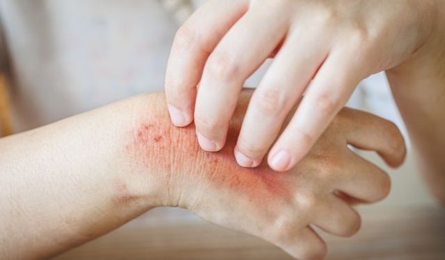 Ciltte Kaşıntıya İyi Gelen Etkili Yöntemler