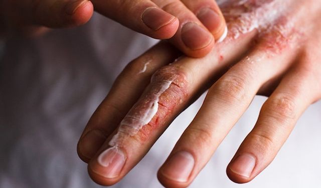 Kışın en sinsi tehlikesi: Basit bir kızarıklık deyip geçmeyin