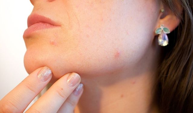 Akne İlacı Kullanmadan Önce Bir Kez Daha Düşünün!