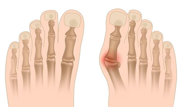 Halluks valgus estetik değil ilerleyici bir sağlık sorunudur