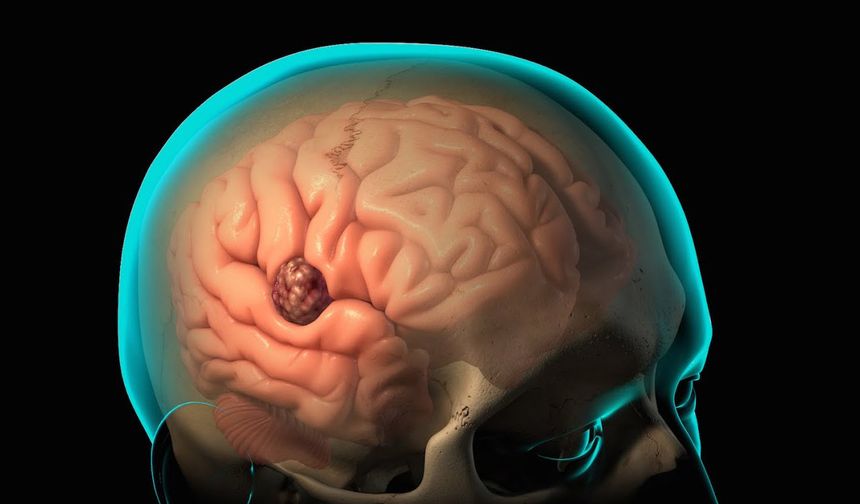 Beyin tümörleri kişilik değişimlerine sebep olabiliyor