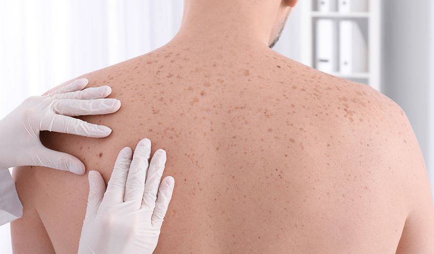 Cilt Kanseri Nedir? Tehlikeli Hücre Büyümesi