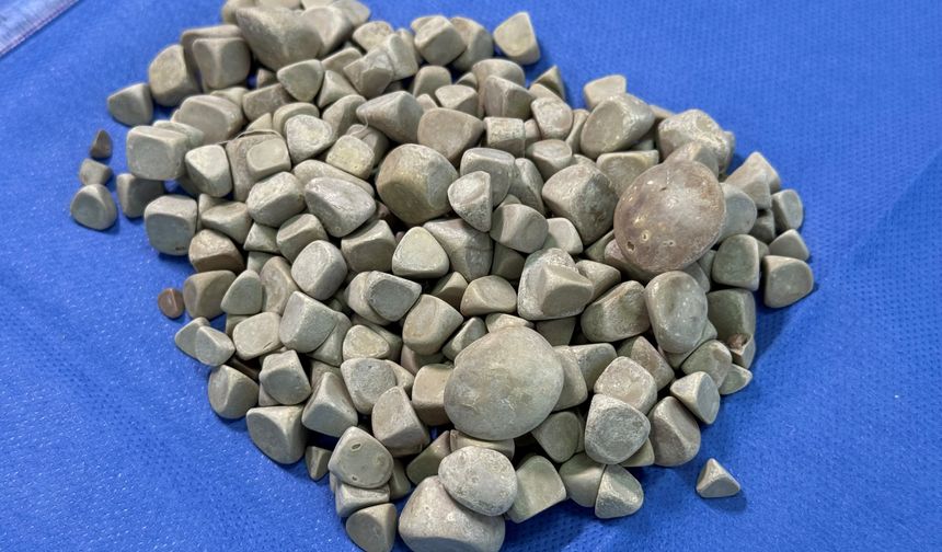 Vücudundan 287 tane taş çıkarıldı