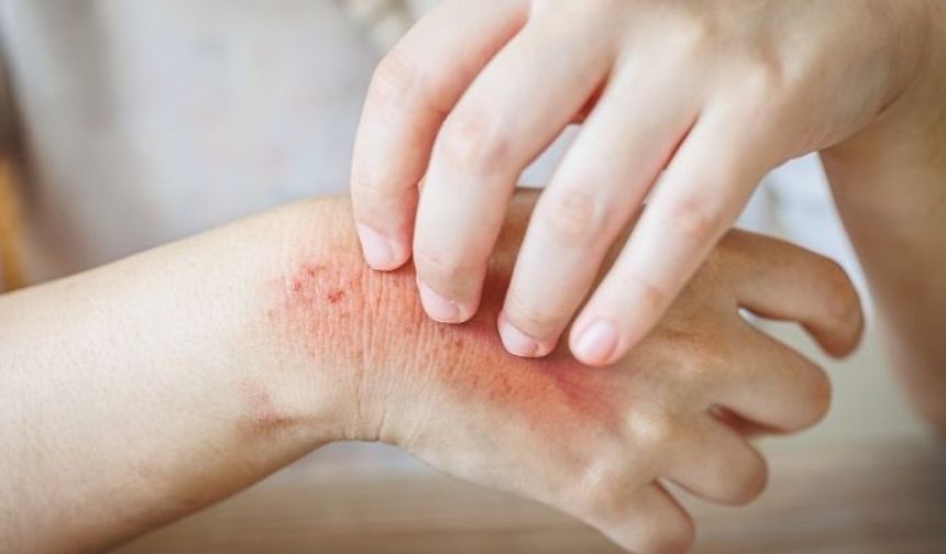 Ciltte Kaşıntıya İyi Gelen Etkili Yöntemler