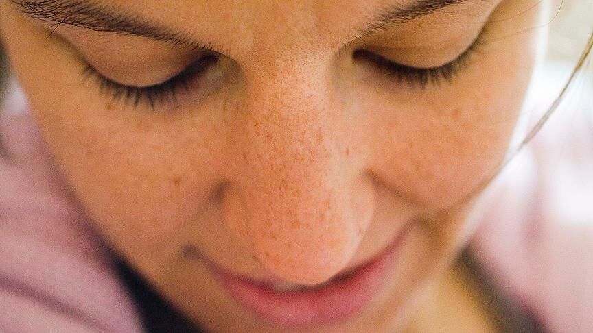 Akne İlacı Kullanmadan Önce Bir Kez Daha Düşünün!